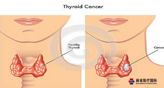 甲狀腺,腫瘤,手術(shù)后,注意事項