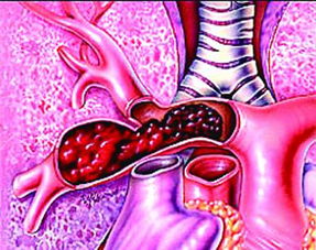 治好,注意事項,肺栓塞