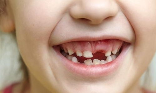 兒童換牙的注意事項,兒童換牙期間注意事項,6歲兒童換牙注意事項