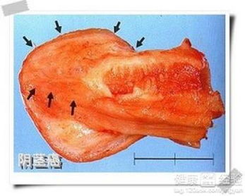 陰莖癌的飲食注意事項