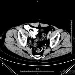 盆腔ct定位注意事項