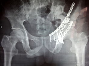 骨折牽引術注意事項