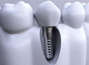 種牙第二期后注意事項(xiàng)