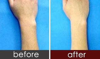 激光脫臉毛后注意事項(xiàng)