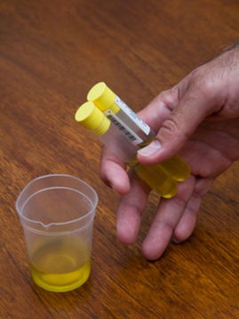 嬰幼兒尿標(biāo)本采集方法及注意事項(xiàng)