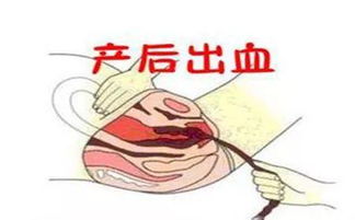 產(chǎn)后出血1000毫升注意事項