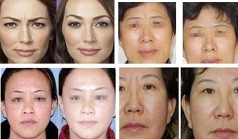 注射botox去川字紋哪些注意事項(xiàng)