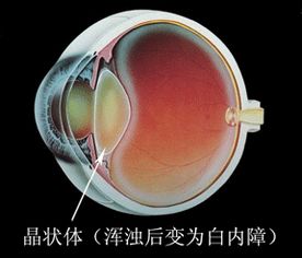 白內(nèi)障注意事項(xiàng)和飲食,術(shù)后白內(nèi)障注意事項(xiàng),白內(nèi)障日常注意事項(xiàng)