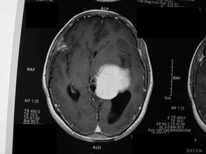 移植,注意事項(xiàng),神經(jīng)