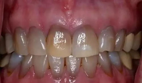 四環(huán)素牙注意事項(xiàng)