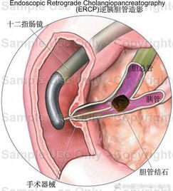 ercp檢查注意事項