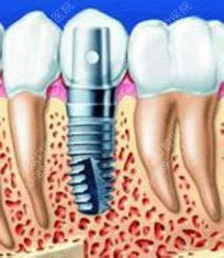 手根再接術(shù)后注意事項