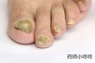 真菌感染口腔護(hù)理注意事項(xiàng),耳朵真菌感染注意事項(xiàng),關(guān)于真菌感染治療的注意事項(xiàng)