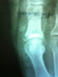 石膏拆了后的注意事項,骨折拆石膏后注意事項,石膏拆除后的護理注意事項