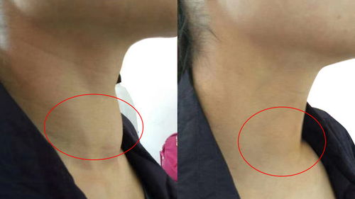 甲狀腺,注意事項(xiàng),平時(shí)