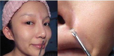 粉刺針清痘后注意事項(xiàng),粉刺瘤切除后注意事項(xiàng),針清閉口粉刺后注意事項(xiàng)