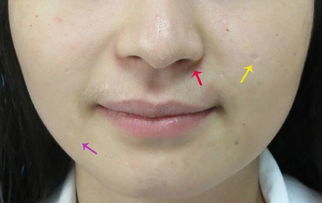 手術去黑痣前注意事項