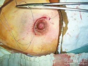 乳腺纖維瘤開刀后注意事項(xiàng)