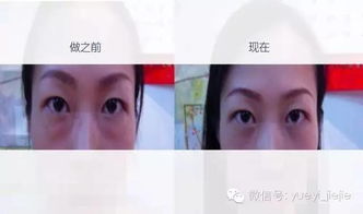 離子光波去眼袋后注意事項