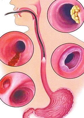 食道癌,晚期,注意事項(xiàng),飲食