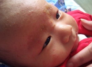 寶寶干性濕疹注意事項