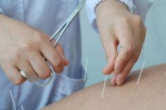 做完淚道栓手術注意事項