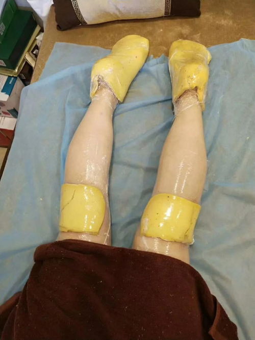 蠟療,病人,注意事項