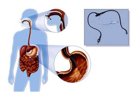 胃鏡切息肉后注意事項(xiàng)