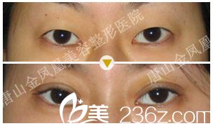 做雙眼皮前后注意事項