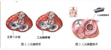 風濕性心臟病介入冶療后注意事項