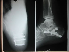 手術(shù),骨折,注意事項(xiàng),固定