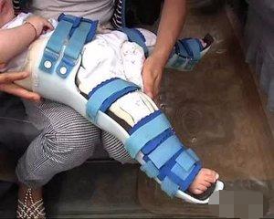 兒童腳趾骨折后注意事項,腳趾骨折護理注意事項,腳趾骨折術后注意事項