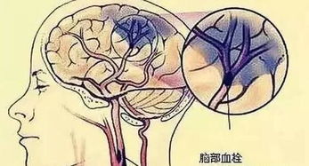 腦血栓溶栓后注意事項,腦血栓出院后注意事項,腦血栓的注意事項