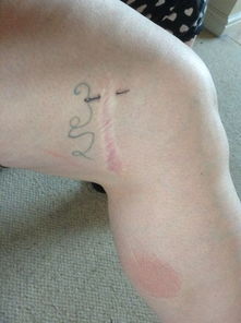 小腿縫針后注意事項