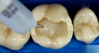 補牙后注意事項與禁忌癥,補牙上藥后注意事項,補牙后的注意事項及飲食