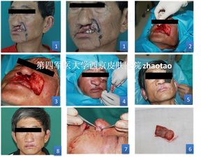 基底細胞癌術(shù)后應注意事項