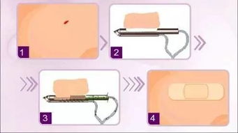 乳房,腫瘤,手術(shù)后,注意事項(xiàng)