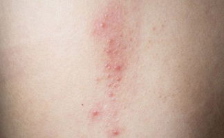 玫瑰康疹注意事項(xiàng)