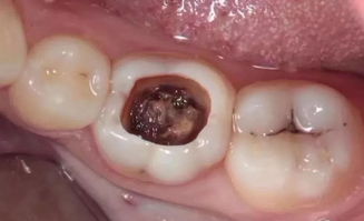 補(bǔ)牙,拔牙,注意事項