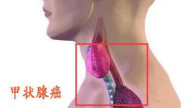 甲狀腺腫瘤切除手術(shù)后飲食注意事項,甲狀腺腫瘤切除手術(shù)后注意事項,做了甲狀腺腫瘤手術(shù)后注意事項