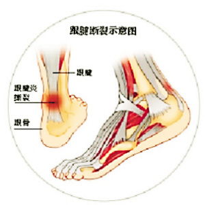 跟腱,康復(fù),注意事項(xiàng)