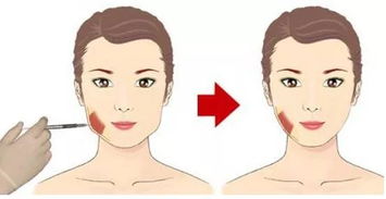 肉毒打咬肌的注意事項