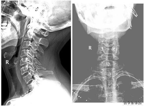 骨折的基礎(chǔ)理論知識