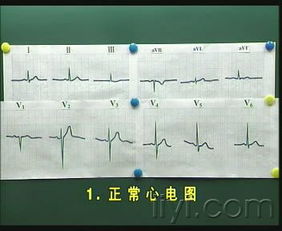 心電圖基礎(chǔ)知識(shí)教學(xué)